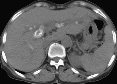 FIG 42-12, Multiple calcified intrahepatic stones formed in the liver in a patient with recurrent pyogenic cholangitis.