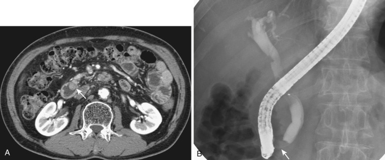 FIG 42-13, Duodenal papillitis due to a passed stone. The duodenal papilla is swollen (arrow) on CT ( A ) and cholangiogram ( B ), and the bile ducts are dilated.