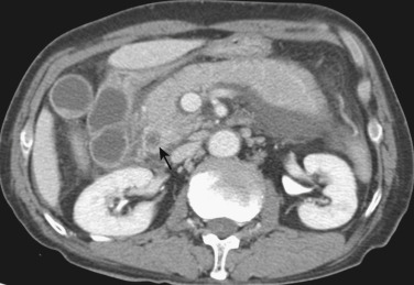 FIG 42-14, Gallstone pancreatitis. The pancreas is enlarged and there is a peripancreatic fluid collection. The common bile duct (arrow) is dilated and the wall is thick. Note the tiny stones in the gallbladder and the thickened gallbladder wall.