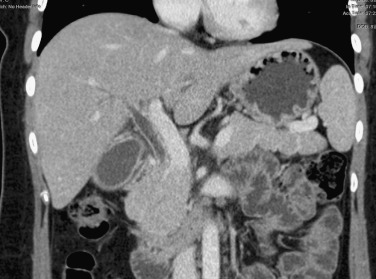 FIG 42-15, Suppurative cholangitis caused by gallbladder stone migration into the common bile duct. Coronal CT shows slightly dilated bile ducts with severe thickening of the walls of the extrahepatic duct and gallbladder.