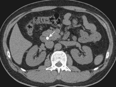 FIG 42-16, Calcified stone (arrow) in the distal common bile duct.