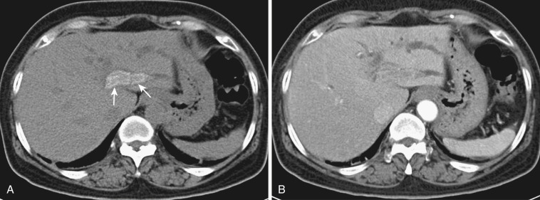 FIG 42-17, A, Heavily calcified left intrahepatic stones (arrows) are seen on precontrast CT. B, The stones are not clearly delineated on postcontrast CT because the adjacent liver parenchyma enhances.