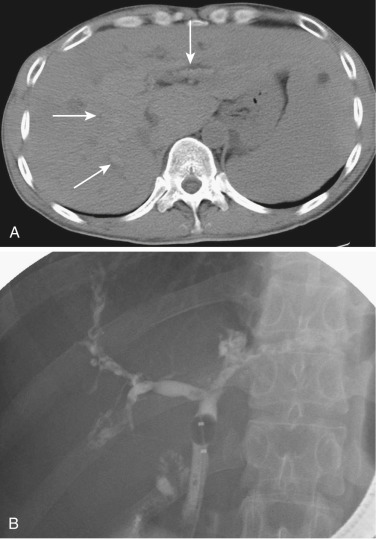 FIG 42-18, Innumerable small intrahepatic stones in a patient with recurrent pyogenic cholangitis. Because attenuation of the stones and liver is similar, CT ( A ) shows several weakly calcified intrahepatic stones (arrows), whereas many stones are visible on cholangiogram ( B ).