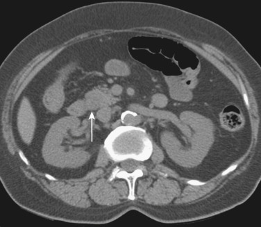 FIG 42-19, Common bile duct stone with soft tissue attenuation (arrow).