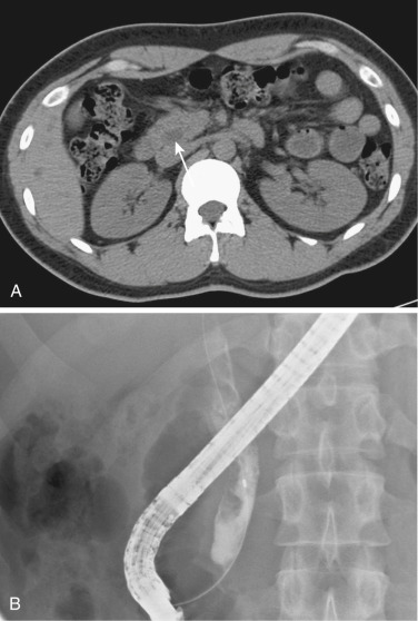 FIG 42-20, Common bile duct stone (arrow) with water attenuation on CT ( A ) and cholangiogram ( B ).