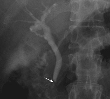 FIG 42-2, Normal ERCP image shows the bile ducts, gallbladder, and main pancreatic duct. The distal part of the common bile duct (arrow) is not seen owing to contraction of the sphincter of Oddi.