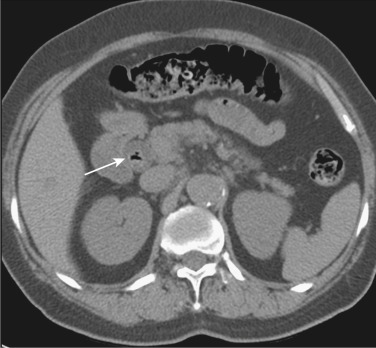 FIG 42-21, Common bile duct stone (arrow) containing air presenting with the “Mercedes-Benz” sign.