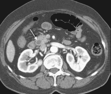 FIG 42-22, Common bile duct stone with rim calcification (arrow) mimicking a bull's-eye.