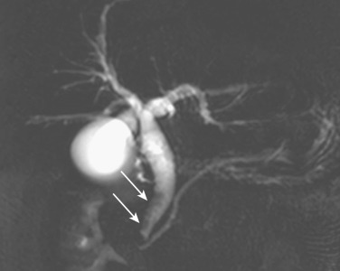 FIG 42-23, Small stone (arrows) in the common bile duct on MR cholangiogram.