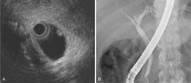 FIG 42-24, Small stone in the common bile duct. Intraductal sonogram discloses a stone ( A ), but there is no stone visible on cholangiogram ( B ).