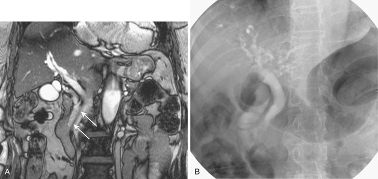 FIG 42-25, Small stones in the common bile duct (arrows) are visualized on MR cholangiogram ( A ) but not on cholangiogram ( B ).