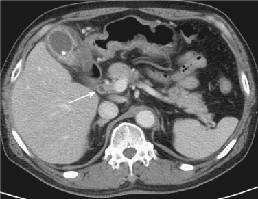 FIG 42-26, Acute suppurative cholangitis caused by a stone originating from the gallbladder. The common bile duct is slightly dilated, and the wall is thick and enhanced as a concentric ring (arrow). The gallbladder contains a small stone and its wall is thick and enhanced owing to acute cholecystitis.