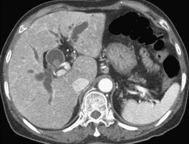 FIG 42-27, Suppurative cholangitis with a common bile duct stone in a patient with recurrent pyogenic cholangitis. Note concentric thickening of the bile duct wall with enhancement.