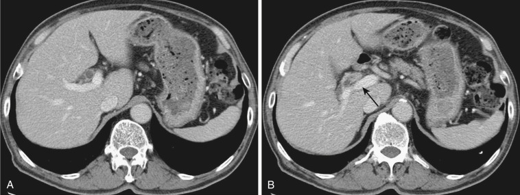 FIG 42-28, A and B, Acute suppurative cholangitis caused by carcinoma of the common hepatic duct ( arrow in B ). Note the dilated bile ducts and concentric thickening of the wall in A .