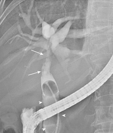 FIG 42-29, Recurrent pyogenic cholangitis. ERCP shows markedly dilated intrahepatic bile ducts with rigidity, decreased arborization, right-angle branching, acute tapering, and the “arrowhead” sign. The extrahepatic duct is also dilated, with proximal narrowing due to segmental fibrous stricture (arrows). Note the large stones (arrowheads) in the distal common bile duct.