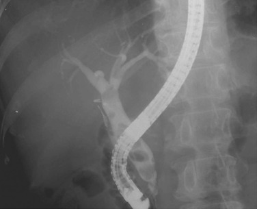 FIG 42-30, Recurrent pyogenic cholangitis. The extrahepatic ducts and lobar and segmental bile ducts are dilated, but the peripheral ducts are obliterated rapidly. Note multiple small stones in the extrahepatic ducts. The gallbladder was resected.