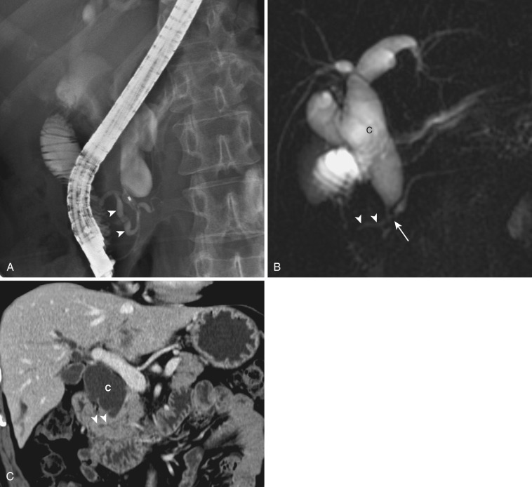 FIG 42-3, Anomalous pancreaticobiliary ductal junction. A, ERCP shows a long common channel measuring more than 15 mm (arrowheads). B, MRCP demonstrates an anomalous pancreaticobiliary ductal junction (arrow) and a choledochal cyst (C). Note the long common channel (arrowheads). C, Coronal MDCT with multiplanar reconstruction demonstrates a long common channel (arrowheads) and choledochal cyst (C).