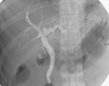 FIG 42-31, ERCP in a patient with common bile duct obstruction caused by a passed stone originating from the gallbladder shows simple dilatation.