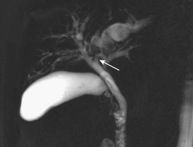 FIG 42-32, Stones in the lateral segmental bile ducts with severe dilatation due to stricture (arrow).