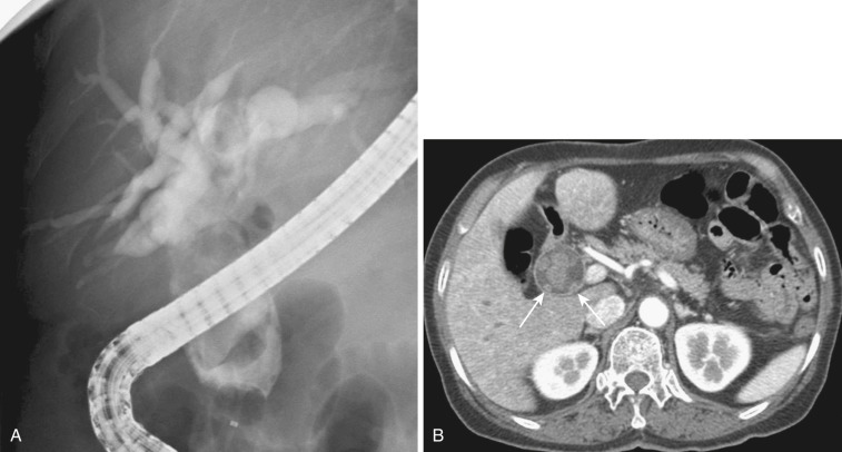 FIG 42-33, Recurrent pyogenic cholangitis. A, Cholangiogram shows severe dilatation and acute peripheral tapering of the intrahepatic bile ducts with the “arrowhead” sign. There are multiple large stones in the extrahepatic duct. B, CT shows a dilated common bile duct and stones within it. Note the thickened wall of the common bile duct (arrows).