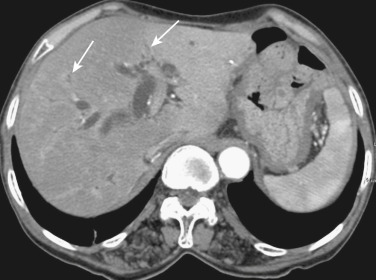 FIG 42-34, Recurrent pyogenic cholangiohepatitis. CT obtained during the arterial phase shows thickening and enhancement of the bile ducts (arrows) and stones in the common bile duct. Note the heterogeneous enhancement of the hepatic parenchyma and periductal enhancement.