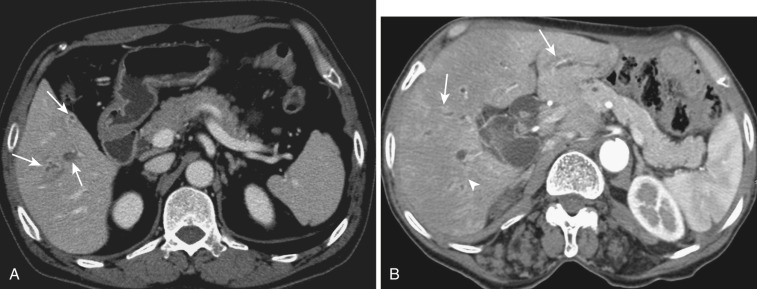 FIG 42-35, A, Multiple liver abscesses (arrows) in a patient with recurrent pyogenic cholangitis. B, In addition to the liver abscesses (arrows), note the small stone in the dilated segmental bile duct (arrowhead).