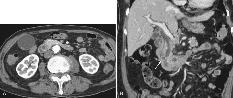 FIG 42-36, Axial ( A ) and coronal ( B ) CT shows a markedly enlarged ampulla of Vater containing a stone that is bulged into the duodenum ( arrow in B ).