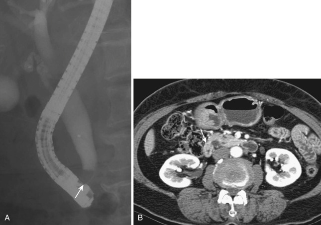 FIG 42-37, Papillary stenosis due to repeated passage of stones. A, ERCP shows dilatation of the extrahepatic ducts. There is normal contraction of the sphincter of Oddi at the end of the common bile duct (arrow). B, CT shows a normal-sized duodenal papilla (arrow).