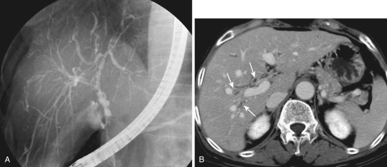 FIG 42-38, Primary sclerosing cholangitis. A, ERCP shows multisegmental or diffuse narrowing and proximal dilatation of the intra- and extrahepatic bile ducts. Peripheral ducts have a “pruned tree” appearance. B, Contrast-enhanced CT shows diffuse thickening of the wall of the intra- and extrahepatic bile ducts (arrows). Also note thickening of the gallbladder wall.