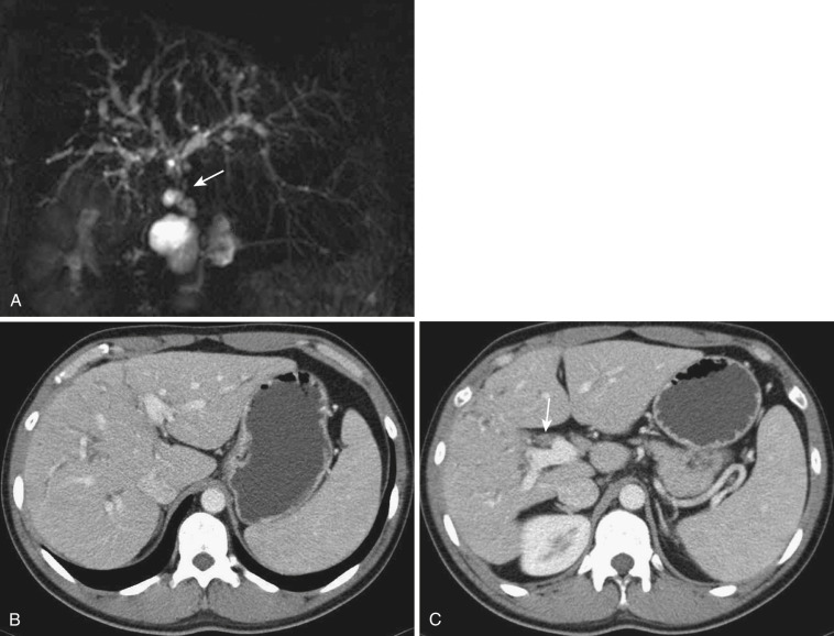 FIG 42-39, Primary sclerosing cholangitis. A, MR cholangiogram shows innumerable foci of focal or segmental narrowing or dilatation of the intrahepatic bile ducts, with a “beaded” appearance and obliteration of the extrahepatic duct (arrow). B and C, CT shows peripheral bile duct narrowing and dilatation, with scattered segments of peripheral duct dilatation. Note obliteration of the lumen of the extrahepatic duct due to severe thickening of the wall ( arrow in C ).