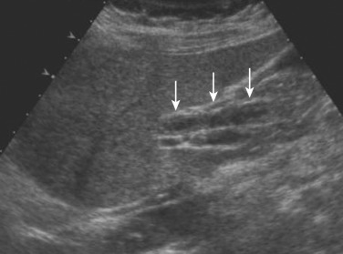 FIG 42-40, Primary sclerosing cholangitis. Sonogram shows the thickened wall of the extrahepatic bile ducts (arrows).