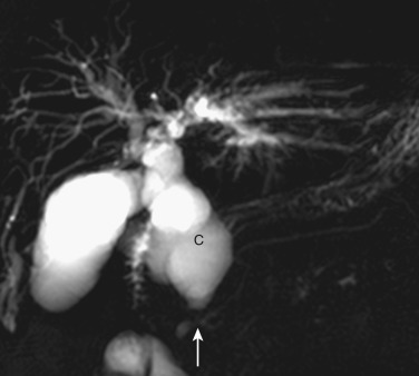 FIG 42-4, Choledochal cyst (C). MRCP demonstrates a markedly dilated common bile duct (choledochal cyst) and aberrant insertion of the common duct into the pancreatic duct (arrow).