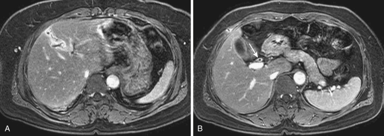 FIG 42-41, A and B, Primary sclerosing cholangitis involving segmental intrahepatic bile ducts and extrahepatic ducts, with thickening of the bile duct wall and intense enhancement ( arrow in B ). The gallbladder wall is also thickened and enhanced.