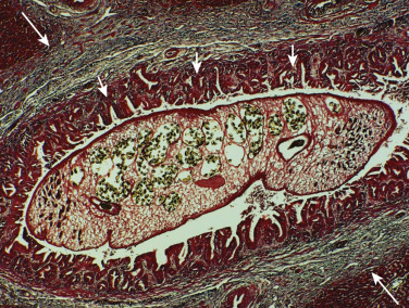 FIG 42-42, Clonorchis sinensis in the bile duct. Photomicrograph from a rabbit liver experimentally infected with C. sinensis shows adult flukes in the bile duct. Note adenomatous hyperplasia of the mucosa (short arrows) and periductal fibrosis (long arrows). (Hematoxylin-eosin; ×40.)