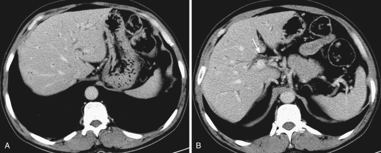 FIG 42-43, Mild clonorchiasis infection. A and B, CT shows mild dilatation of the peripheral intrahepatic bile ducts, without dilatation of the central duct ( arrow in B ).