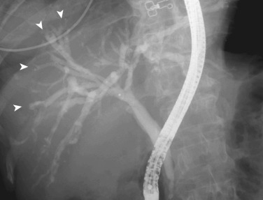 FIG 42-44, Clonorchiasis. Endoscopic retrograde cholangiogram shows innumerable small elliptical filling defects in the bile ducts, representing adult Clonorchis sinensis. Filling of the peripheral duct is impeded by flukes (arrowheads). The intrahepatic ducts are dilated, but the extrahepatic bile ducts are not.