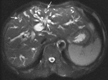 FIG 42-45, Severe clonorchiasis. MRI shows severe dilatation of the intrahepatic bile ducts up to the periphery of the liver. Adult flukes are visible in the bile ducts (arrows).