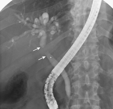 FIG 42-46, Clonorchiasis and cholangiocarcinoma of the common hepatic duct. Endoscopic retrograde cholangiogram shows markedly dilated intrahepatic bile ducts containing multiple elliptical filling defects due to adult flukes of Clonorchis sinensis. Arrows point to the segment of cholangiocarcinoma.