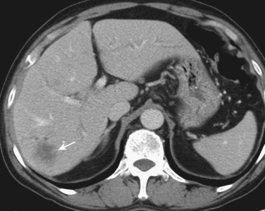 FIG 42-47, Peripheral cholangiocarcinoma (arrow) in a patient with clonorchiasis, which has caused dilatation of the peripheral bile ducts.