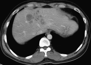 FIG 42-48, Hepatic fascioliasis. CT shows multiple small, clustered, necrotic lesions in the subcapsular area arranged as “tunnels and caves.”