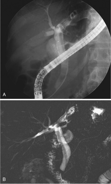 FIG 42-50, Biliary ascariasis. Endoscopic retrograde cholangiogram ( A ) and MRCP ( B ) show a long convoluted filling defect in the extrahepatic ducts representing adult Ascaris lumbricoides.