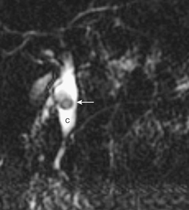 FIG 42-5, Choledochal cyst (C) with a small stone (arrow) on MRCP.