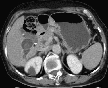 FIG 42-51, Bile duct stricture caused by thermal injury during radiofrequency ablation for hepatocellular carcinoma. CT shows severe dilatation of the posterior segmental bile ducts abutting the necrotic nodule.