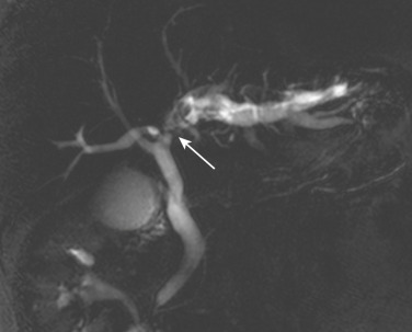 FIG 42-53, Tight stricture (arrow) at the left hepatic duct in a patient with recurrent pyogenic cholangitis. Note stones in the left hepatic duct proximal to the stricture site.