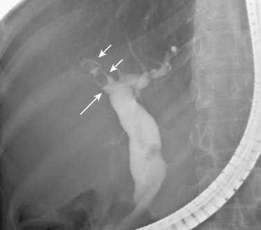 FIG 42-54, Stricture of bile duct in recurrent pyogenic cholangitis. The posterior segmental branch of the right hepatic duct is missing (“missing duct” sign; long arrow ). Note two stones in the anterior segmental bile duct (short arrows).