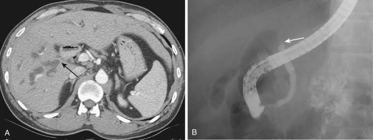 FIG 42-55, Iatrogenic stricture of the common hepatic duct after cholecystectomy. A, CT shows intrahepatic bile duct dilatation and abrupt stricture at the confluence of the rigid hepatic duct (arrow). B, Cholangiogram shows complete obstruction at the bifurcation (arrow).