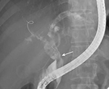 FIG 42-56, Mild bile duct stricture (arrow) at the site of anastomosis after liver transplantation. There are many stones and debris in the bile ducts proximal to the stricture.