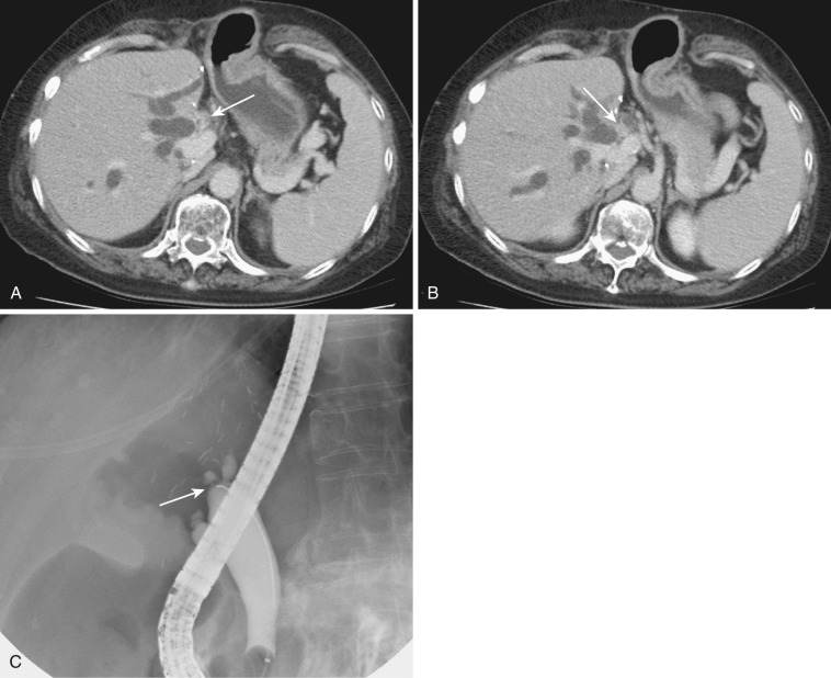 FIG 42-57, Bile duct stricture at the site of anastomosis in a liver transplant patient. A and B, CT shows fibrous thickening of the anastomosis site (arrow) between the dilated intrahepatic ducts and the extrahepatic duct. C, ERCP shows the tight stricture at the anastomosis site (arrow).