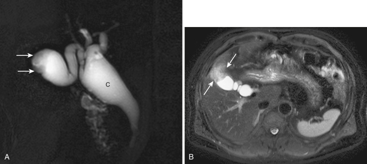 FIG 42-6, Gallbladder cancer associated with choledochal cyst (C). A, MRCP shows a lobulated filling-defect lesion (arrows) in the gallbladder. B, T2-weighted transverse MRI demonstrates gallbladder cancer (arrows).