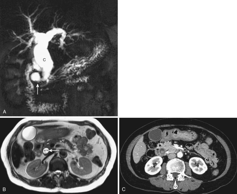 FIG 42-7, Choledochocele. A, MRCP shows a choledochal cyst (C) and choledochocele (arrow). T2-weighted transverse MRI ( B ) and MDCT ( C ) show a small cholangiocarcinoma (arrow) within the choledochocele.